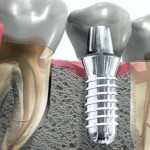 implantologia dentale