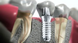 implantologia dentale