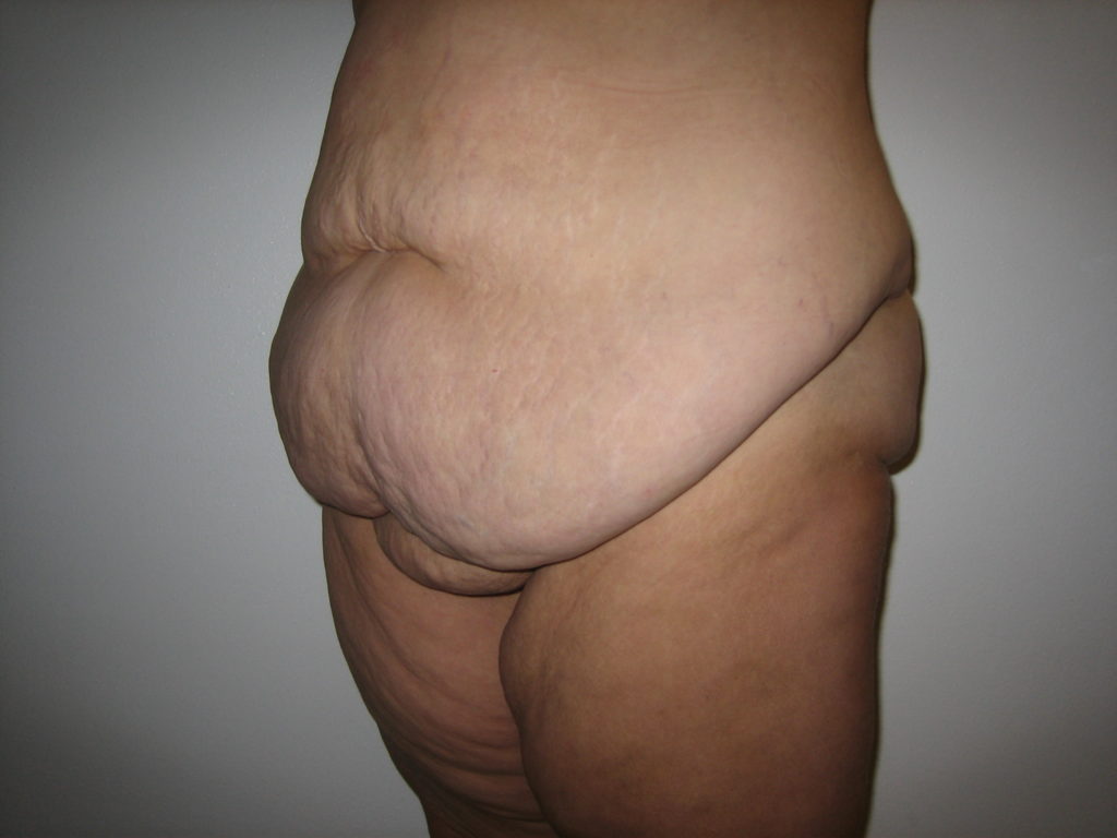 addominoplastica-intervento