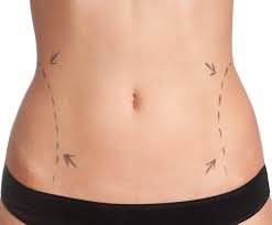 interventi-di-addominoplastica