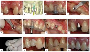 casa implantologia dentale