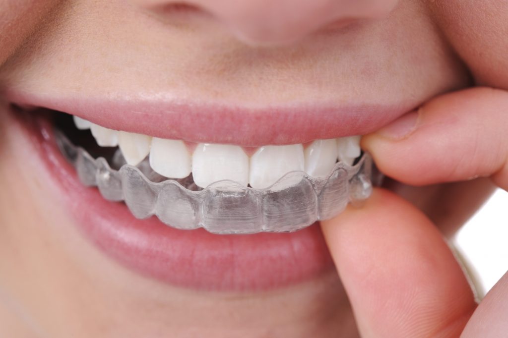 Utilizzare gli apparecchi per denti invisibili