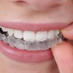 Utilizzare gli apparecchi per denti invisibili
